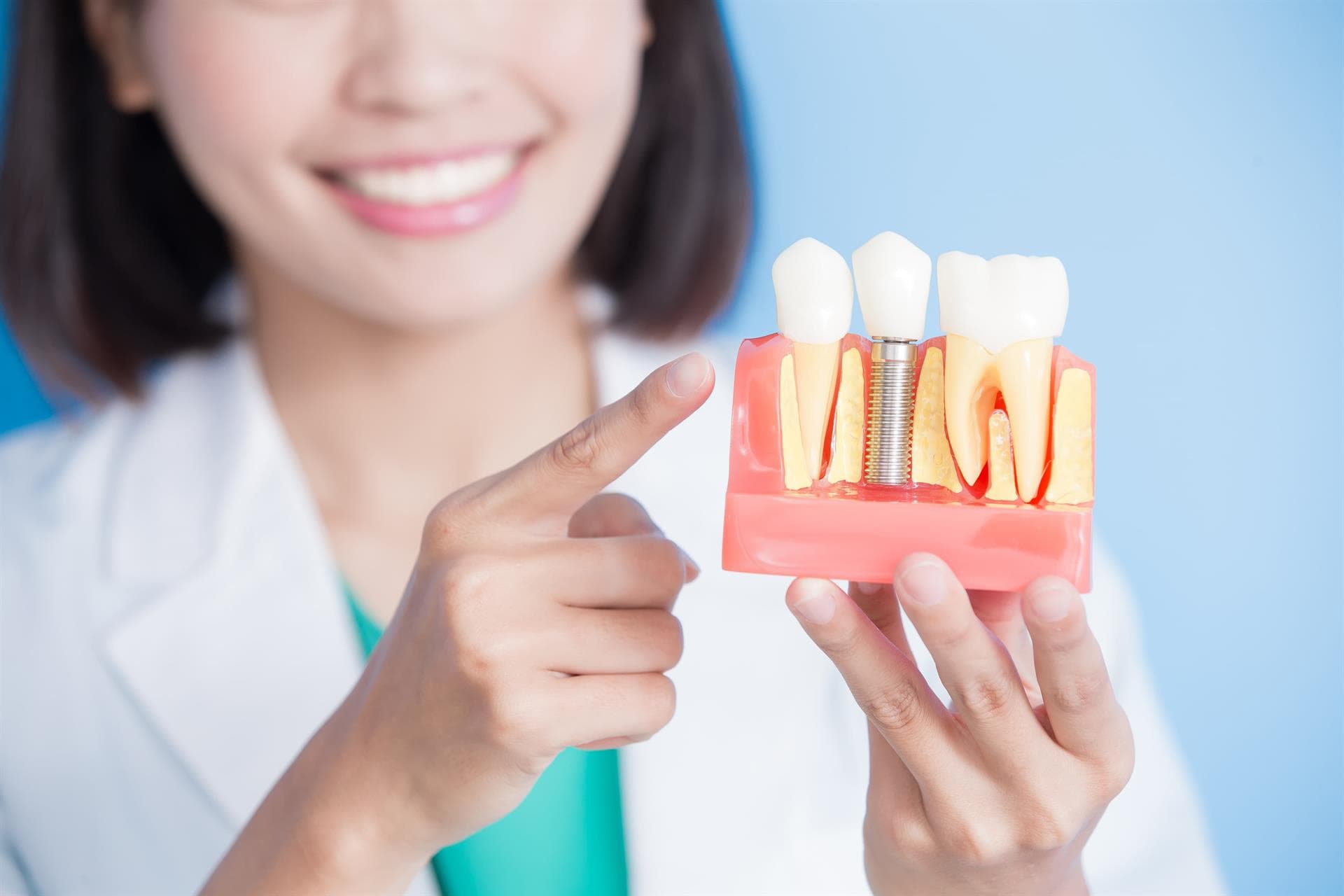 ¿Cómo actúan los implantes dentales?
