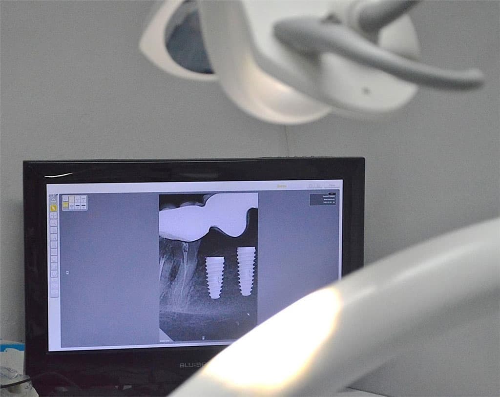 Beneficios de nuestros implantes dentales en Rianxo