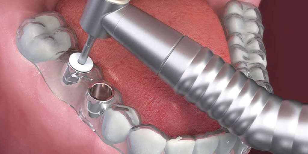 ¿Cómo actúan los implantes dentales de Rianxo Dental?