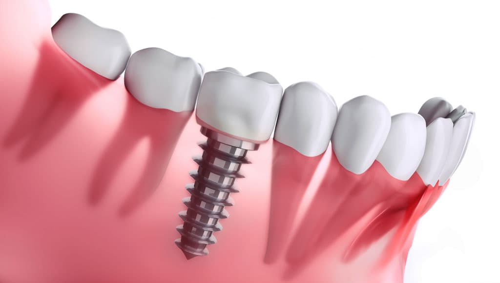 Conozca su plan de implantes a medida