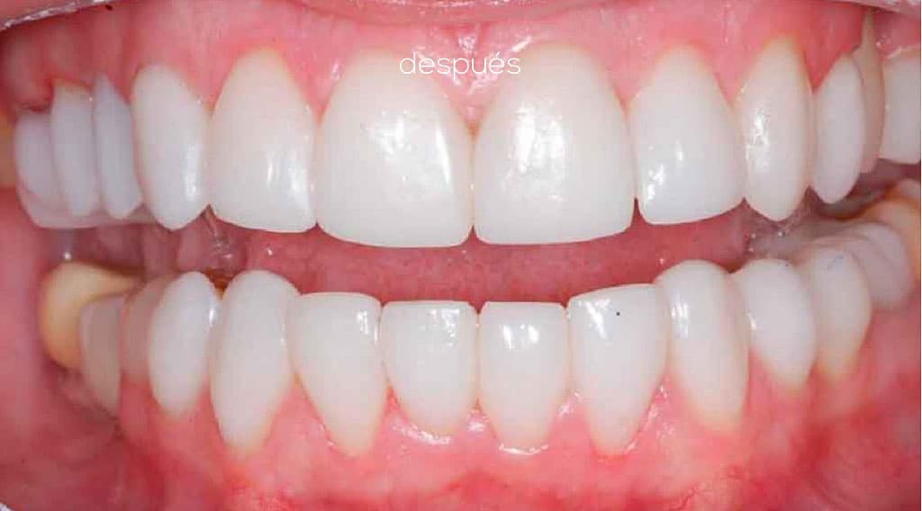 ¿Cuánto tiempo duran las carillas de porcelana?