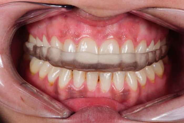 ¿Qué es y cómo tratamos en Rianxo Dental el bruxismo?
