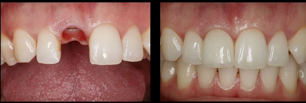 Rianxo Dental encontrará solución a su falta de dientes