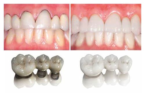 Ventajas de las coronas y puentes dentales