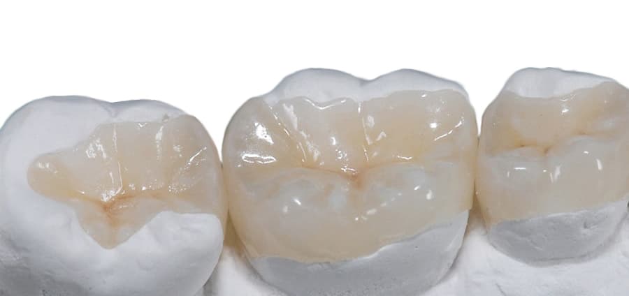 Tipos de incrustaciones dentales