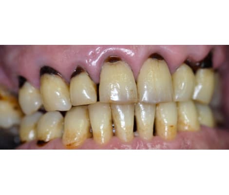 Limpieza profunda y meticulosa de la superficie dentaria antes