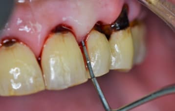 ¿Cuál es el tratamiento periodontal?