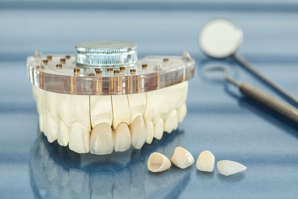 Ventajas de nuestras coronas y puentes dentales
